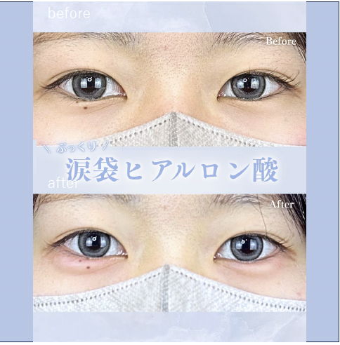 涙袋ヒアルロン酸の症例写真