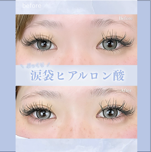 涙袋ヒアルロン酸の症例写真