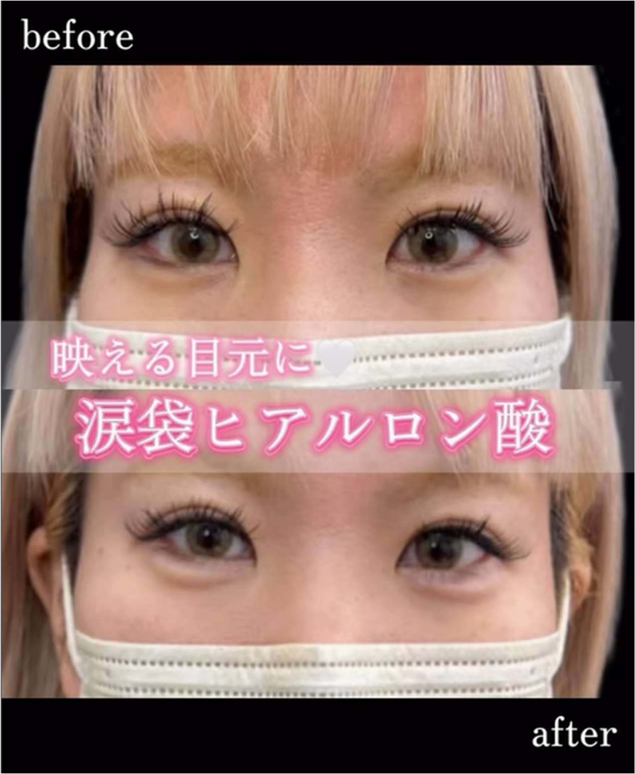 涙袋ヒアルロン酸の症例写真