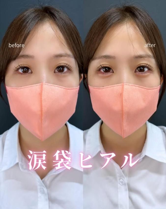 涙袋ヒアルロン酸の症例写真