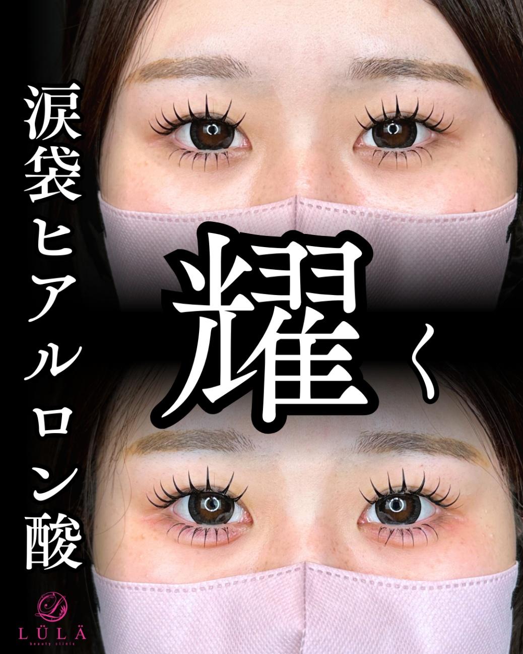 涙袋ヒアルロン酸の症例写真