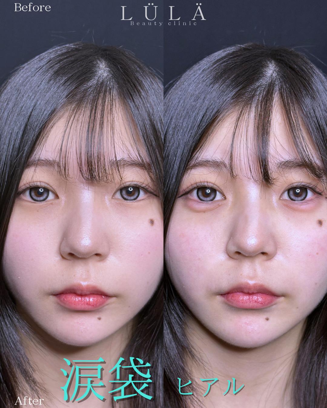 涙袋ヒアルロン酸の症例写真