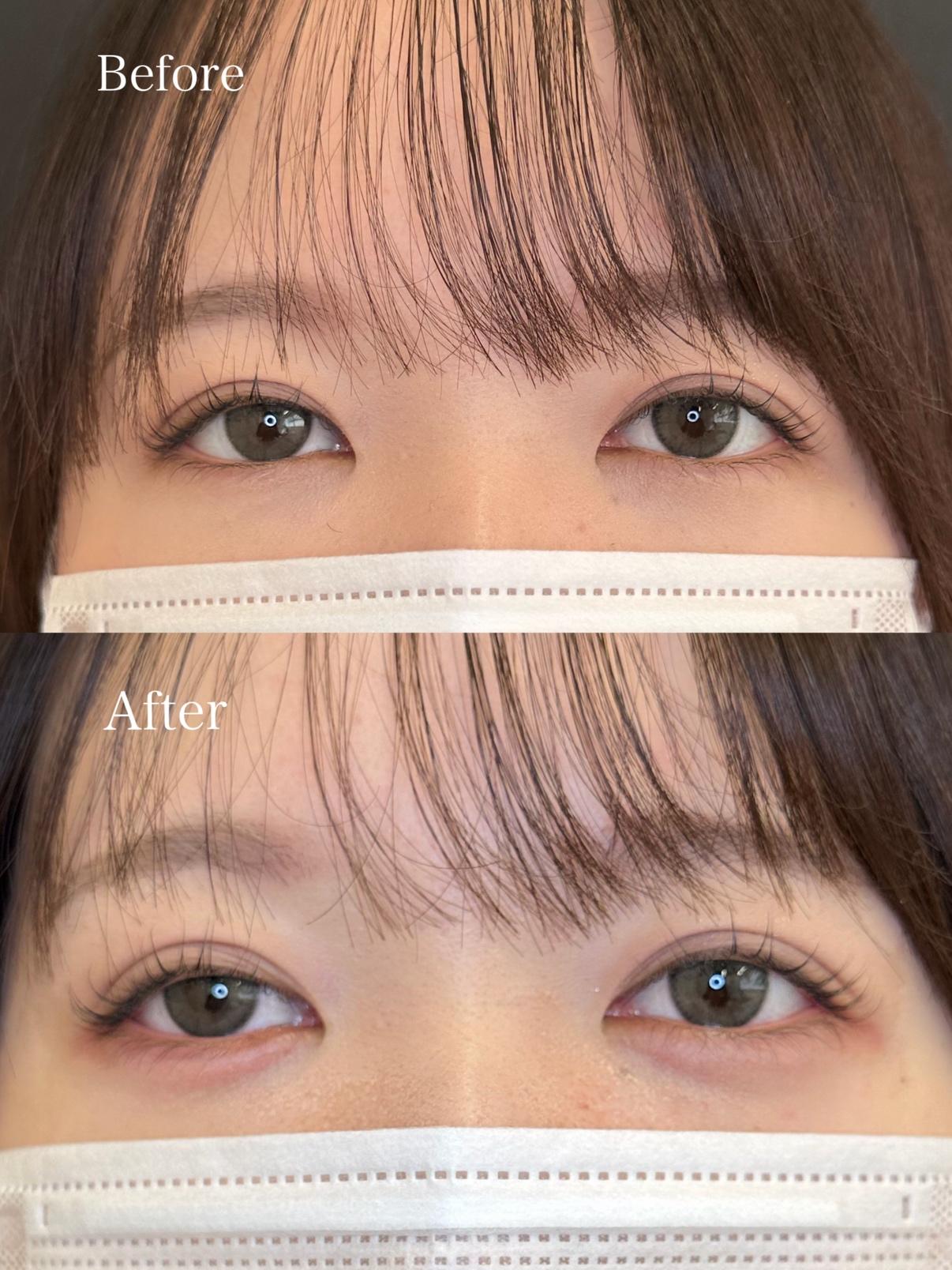 涙袋ヒアルロン酸の症例写真