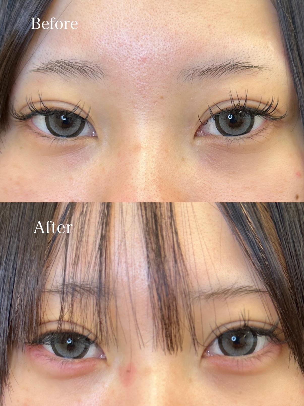 涙袋ヒアルロン酸の症例写真