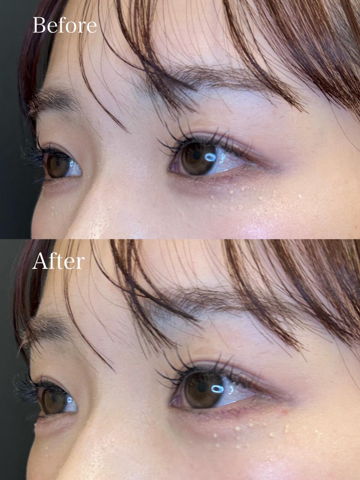 涙袋ヒアルロン酸の症例写真