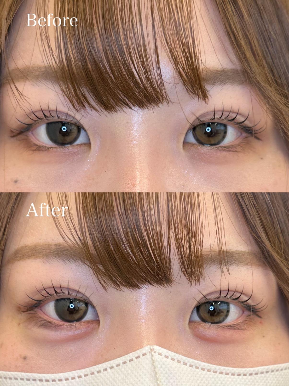 涙袋ヒアルロン酸の症例写真