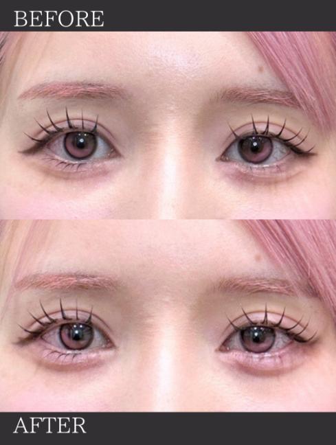 涙袋ヒアルロン酸の症例写真