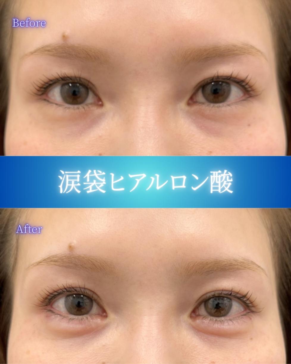 涙袋ヒアルロン酸の症例写真