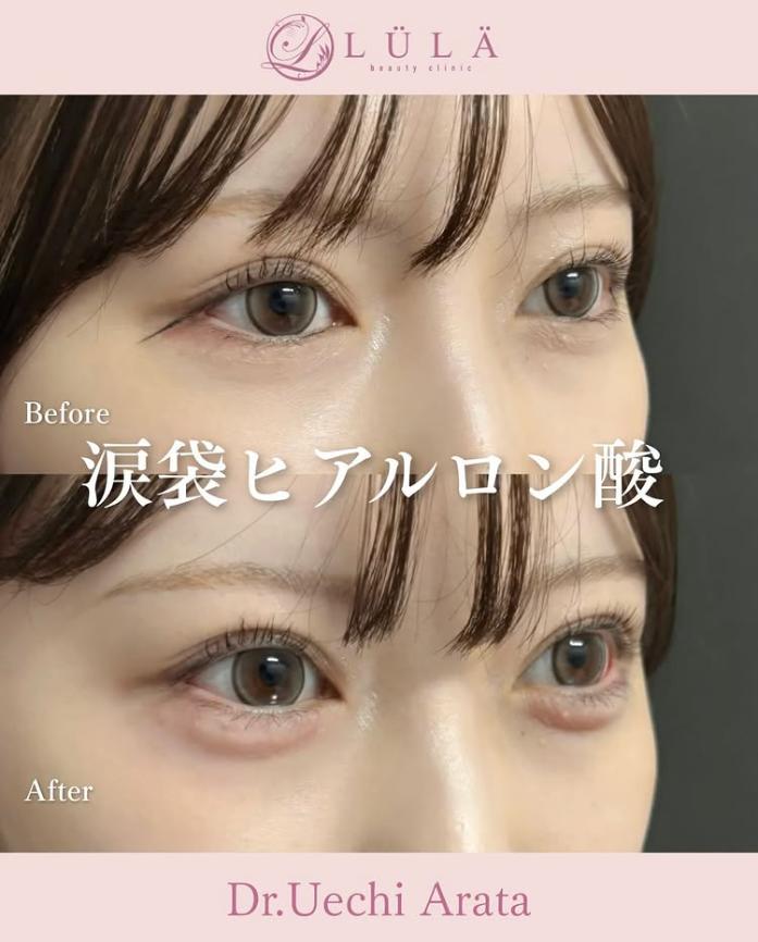 涙袋ヒアルロン酸の症例写真