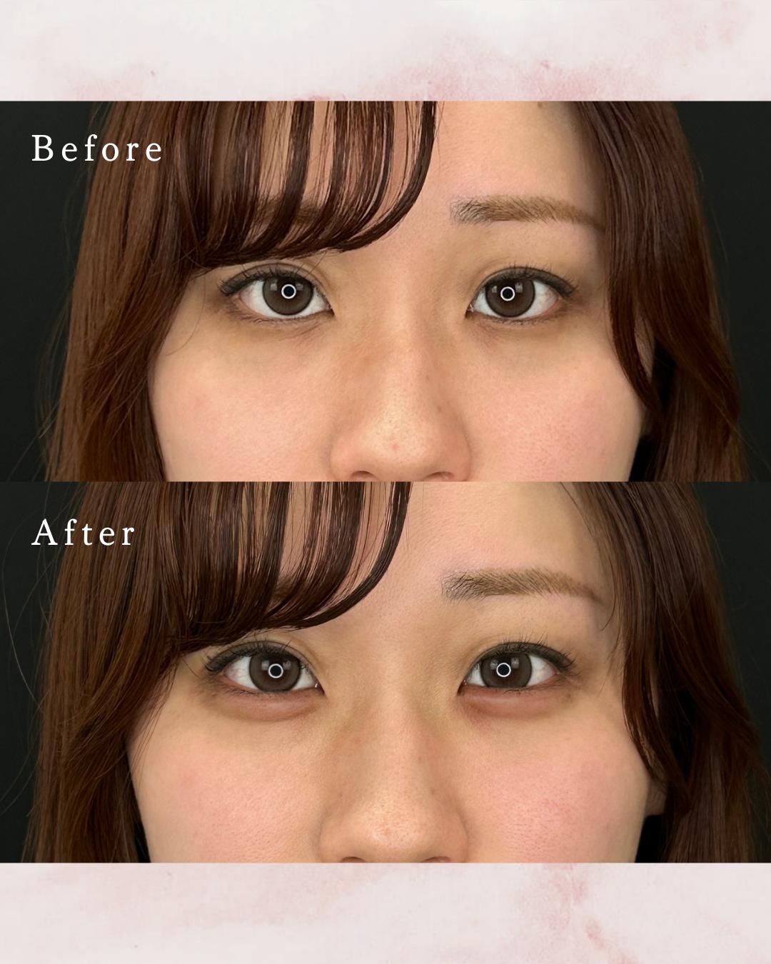 涙袋ヒアルロン酸の症例写真