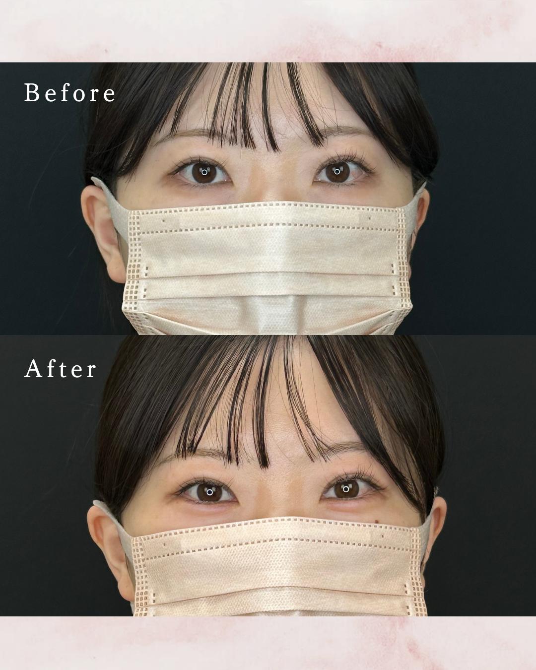 涙袋ヒアルロン酸の症例写真