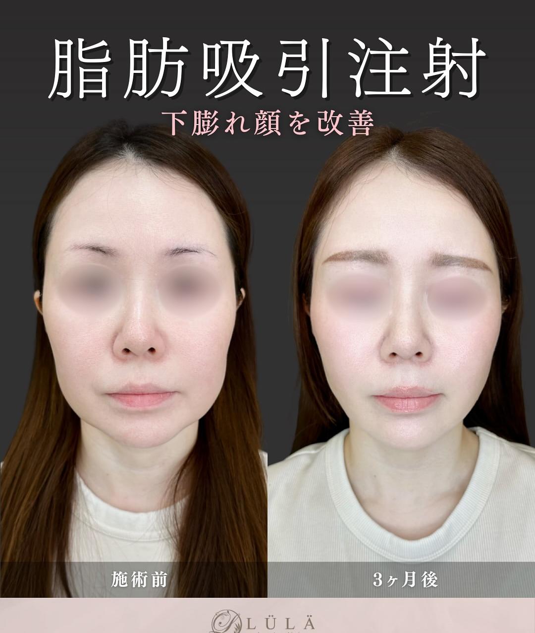 脂肪吸引の症例写真