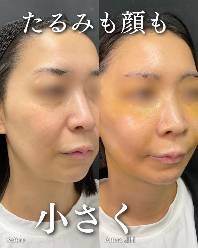 前額リフトの症例写真