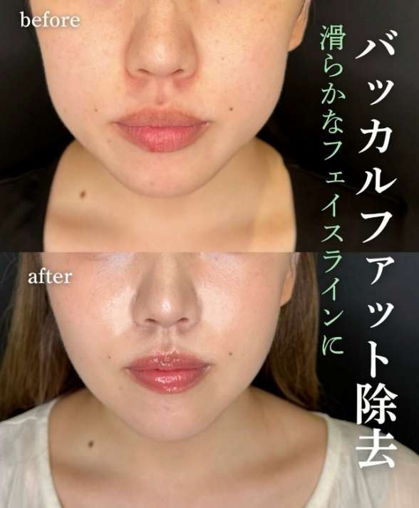 バッカルファット除去の症例写真