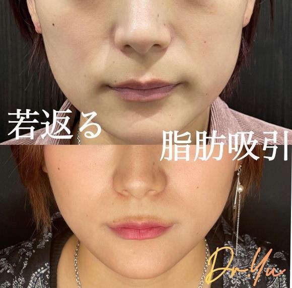 顔の脂肪吸引の症例写真