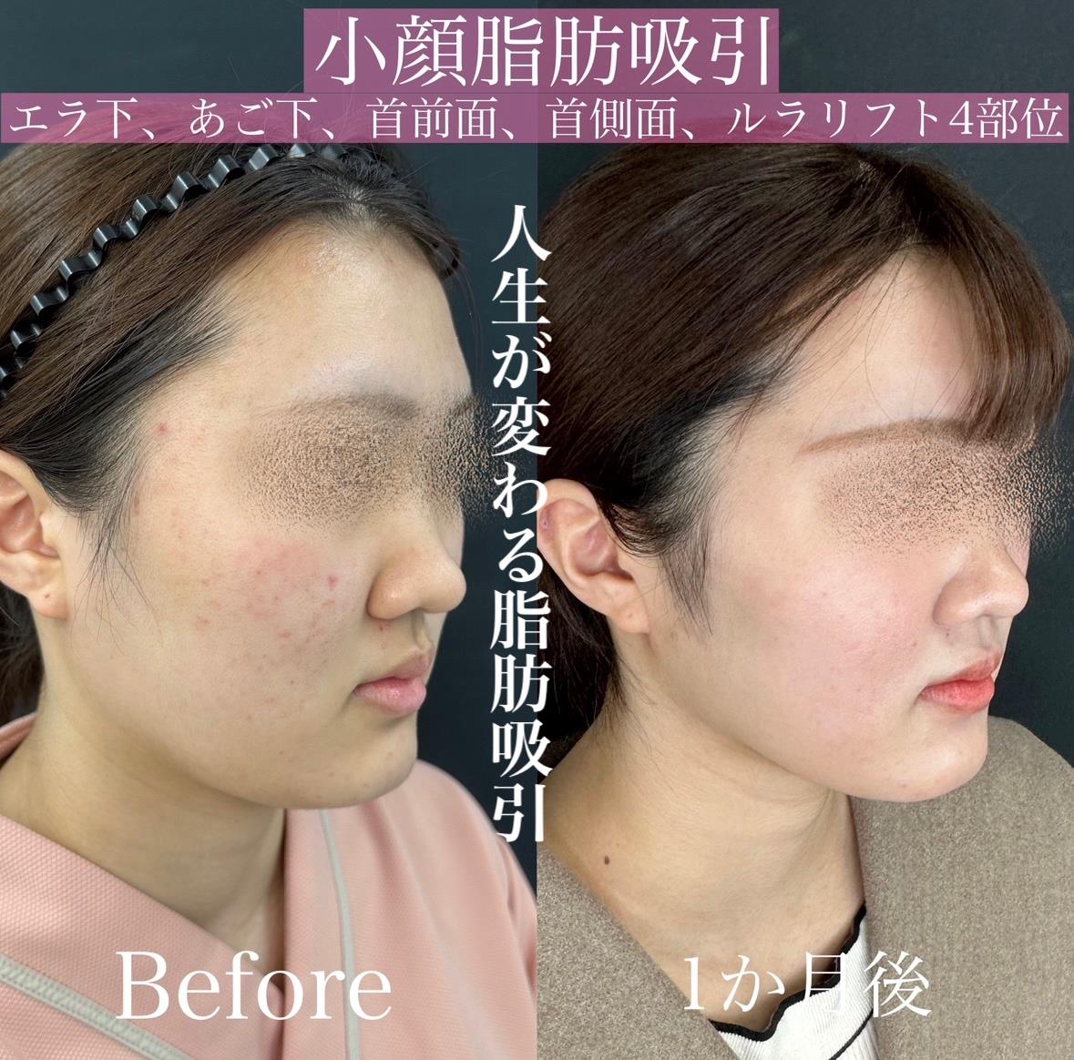 脂肪吸引の症例写真