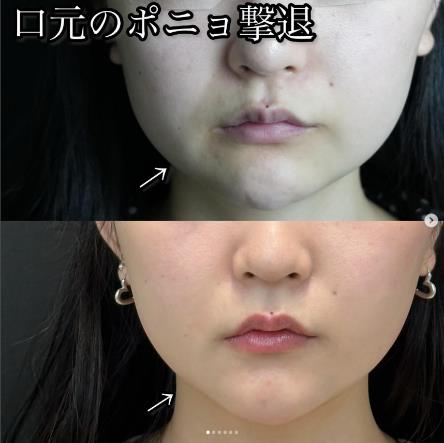 脂肪吸引の症例写真