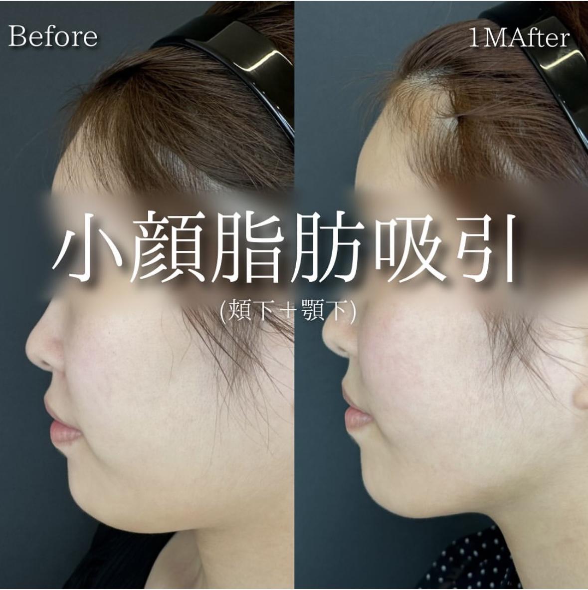 脂肪吸引の症例写真