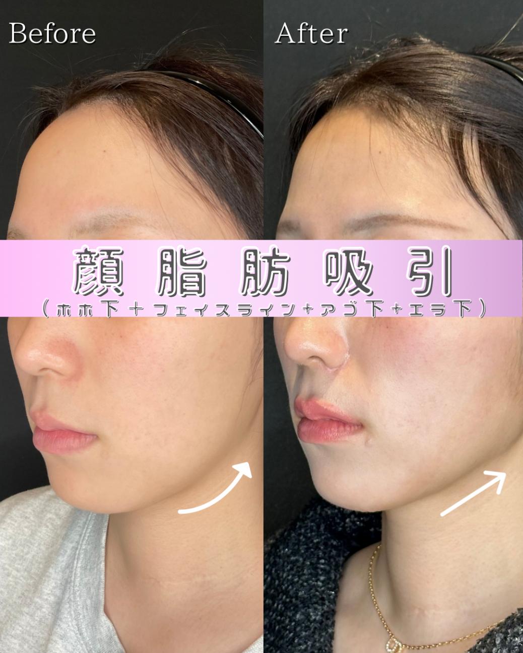 脂肪吸引の症例写真
