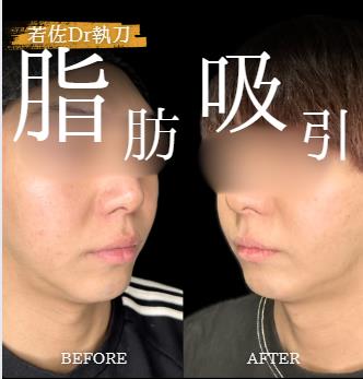 脂肪吸引の症例写真