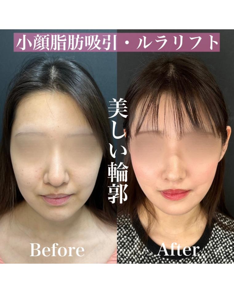 脂肪吸引の症例写真