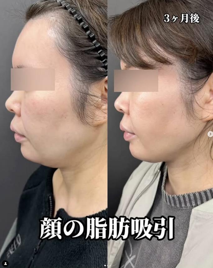 脂肪吸引の症例写真