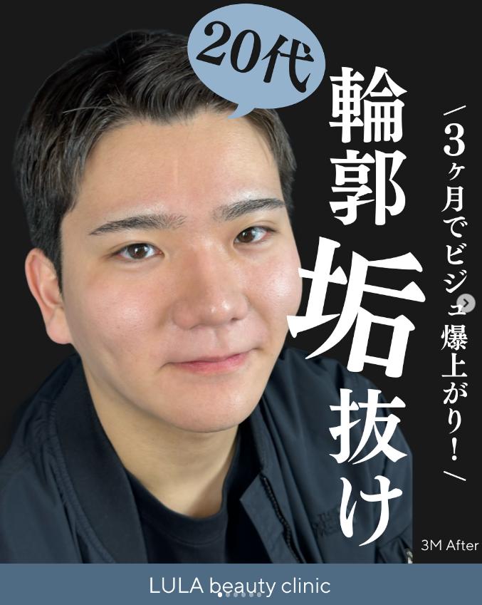 脂肪吸引の症例写真