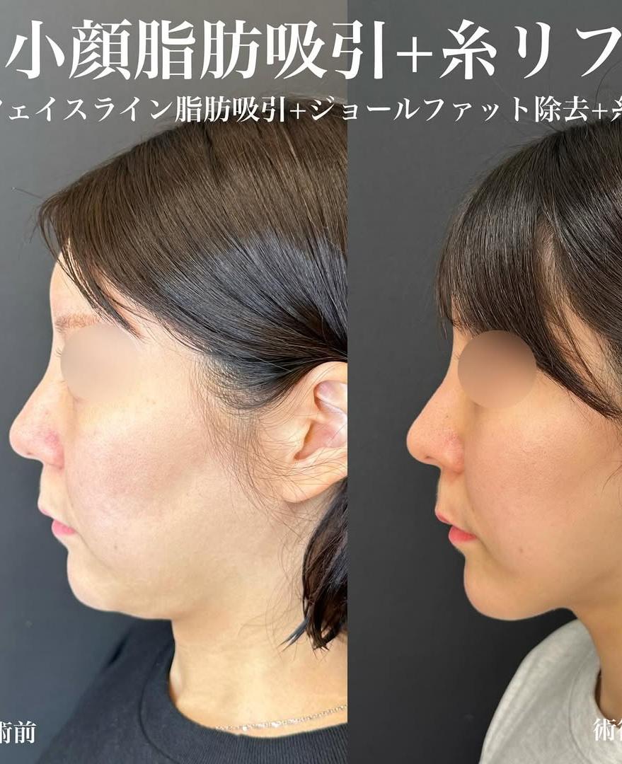 脂肪吸引の症例写真