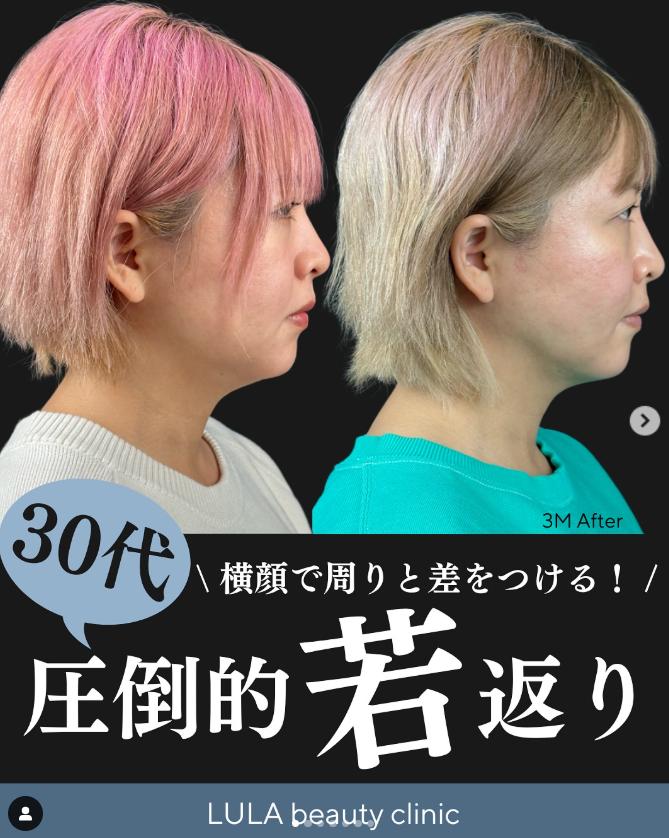 脂肪吸引の症例写真
