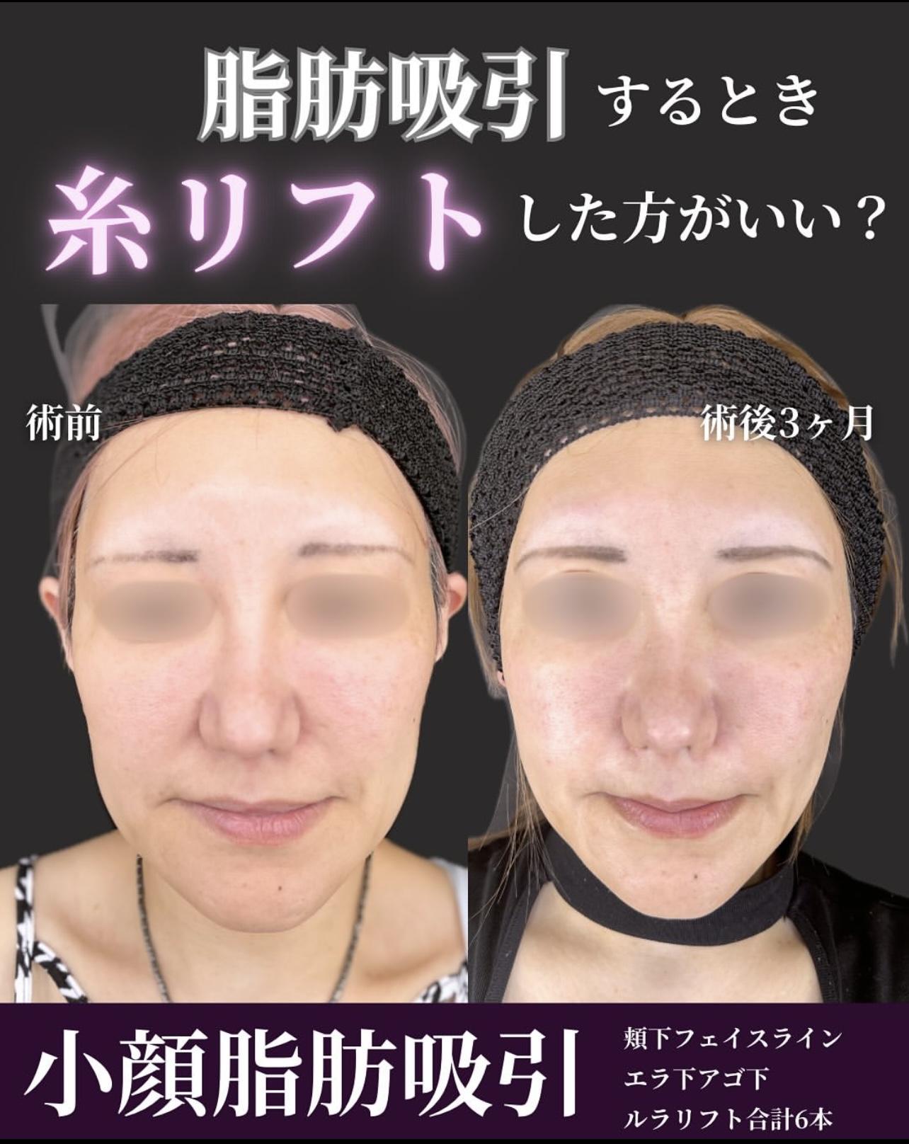 脂肪吸引の症例写真