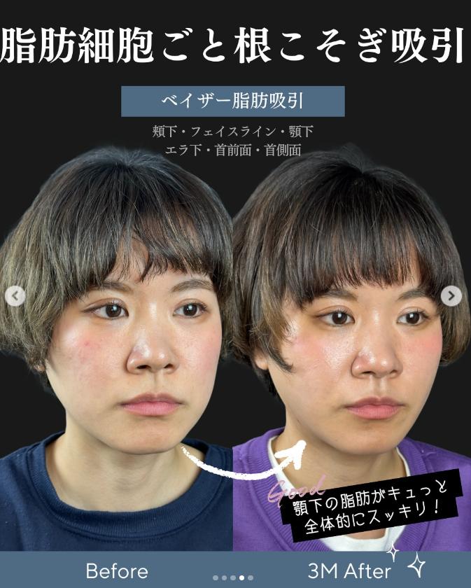 脂肪吸引の症例写真