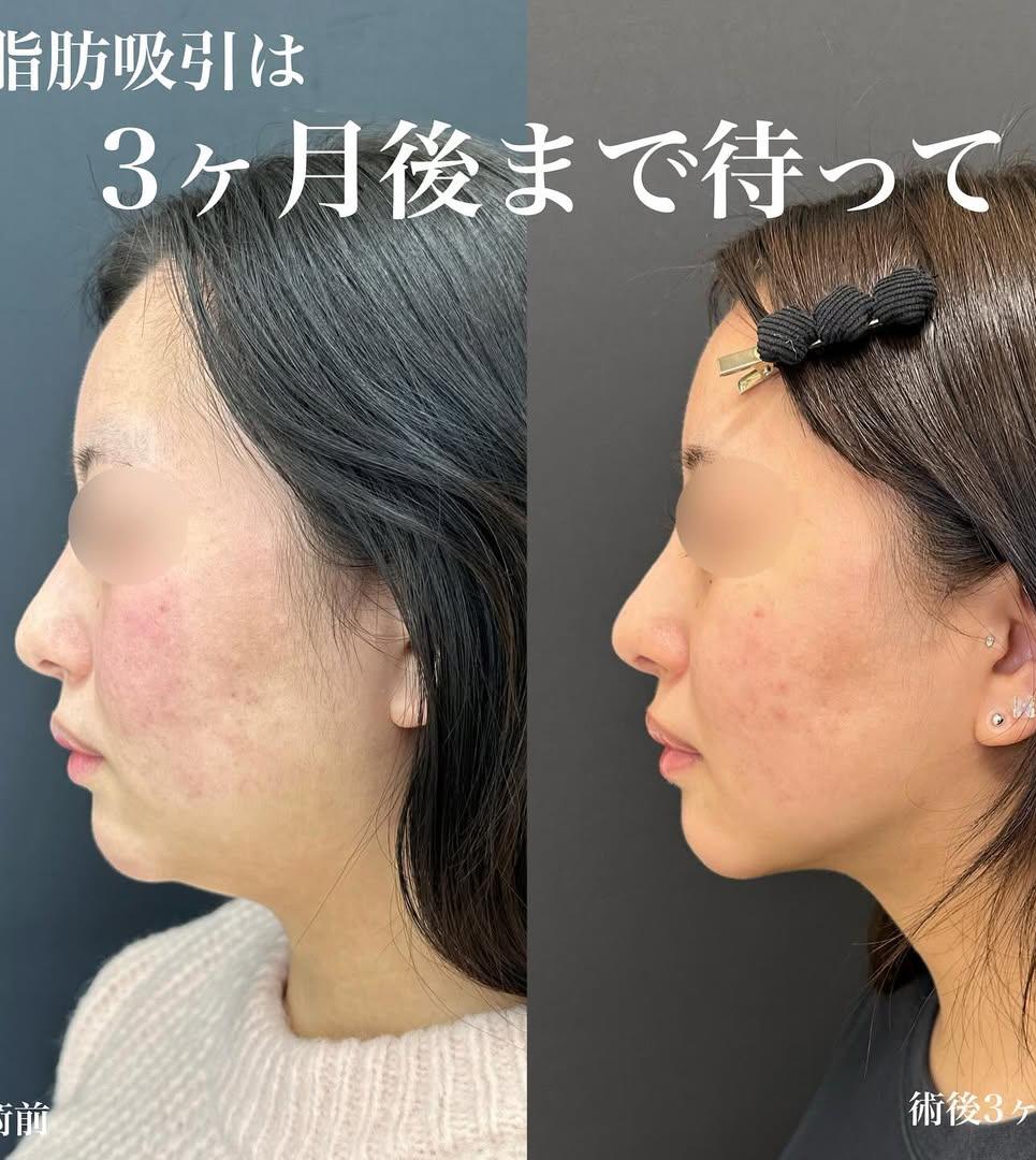 脂肪吸引の症例写真
