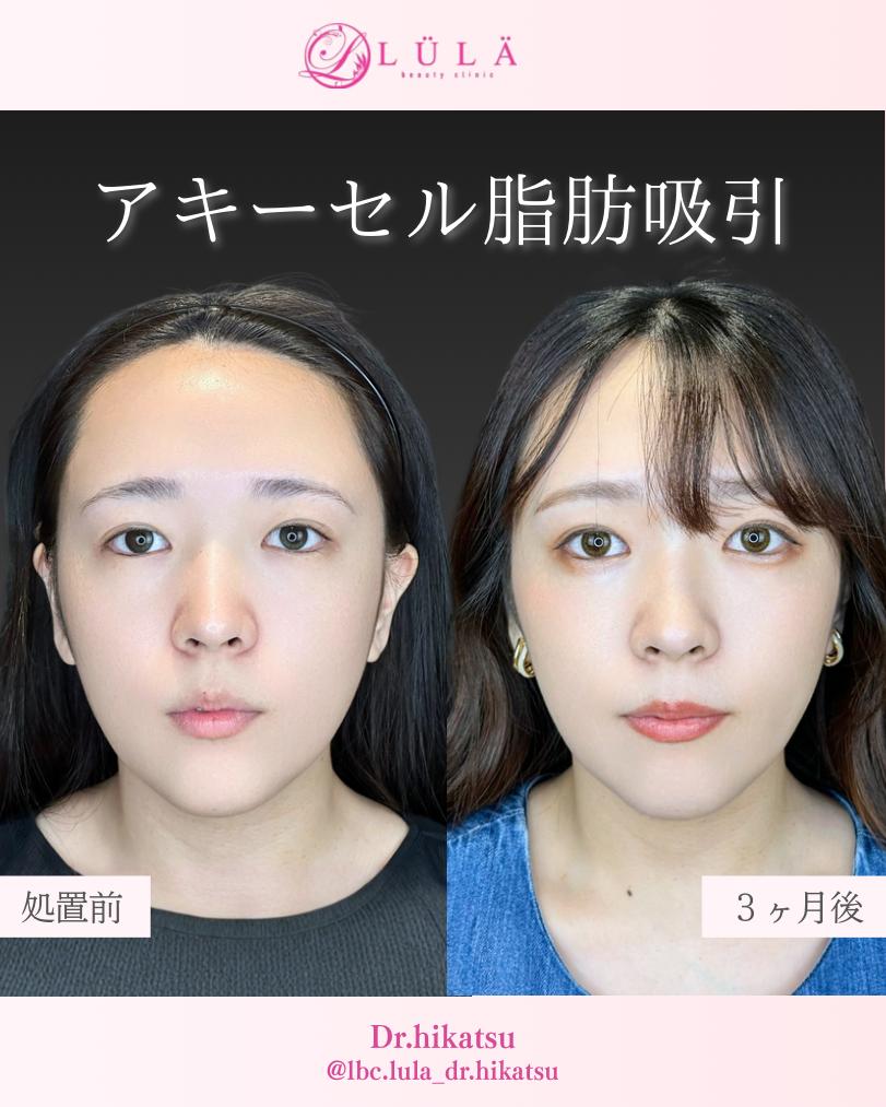 脂肪吸引の症例写真