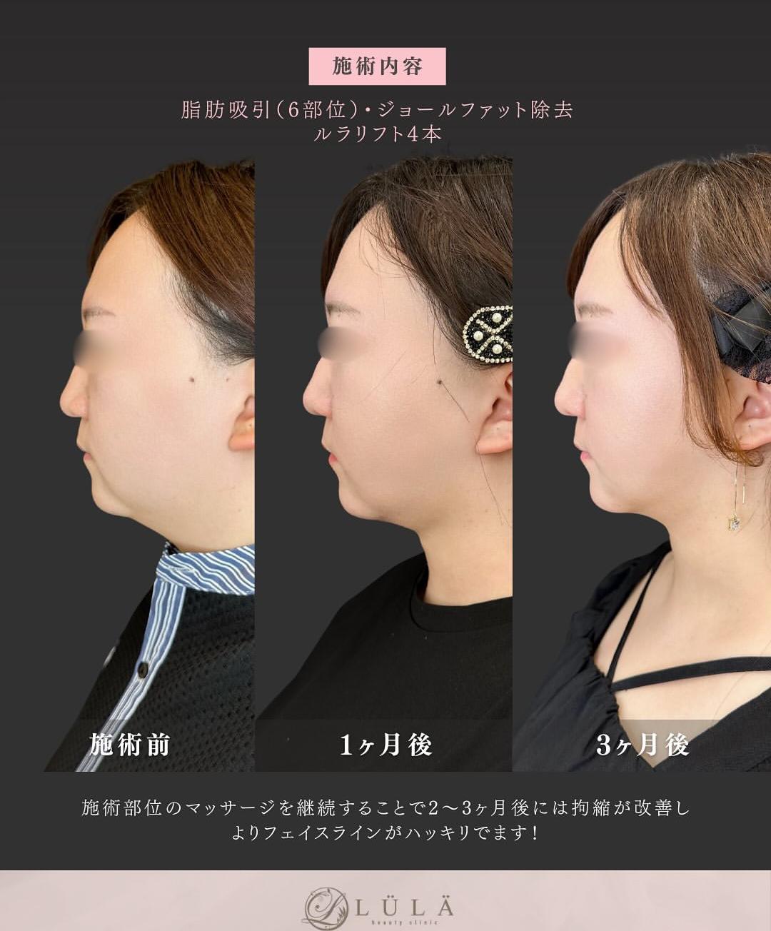 脂肪吸引の症例写真