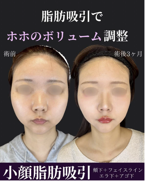 脂肪吸引の症例写真