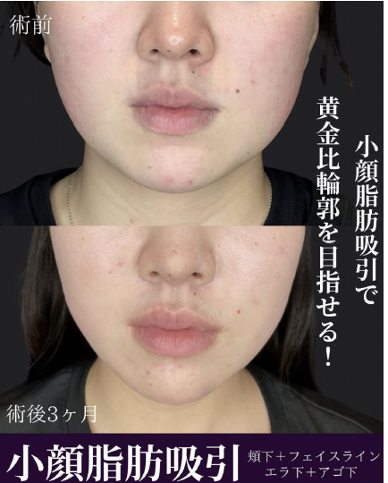 脂肪吸引の症例写真