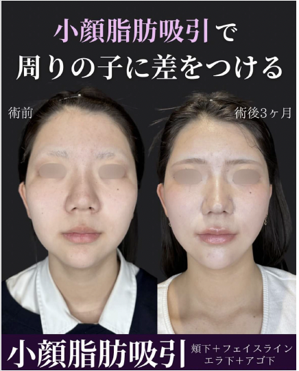 脂肪吸引の症例写真