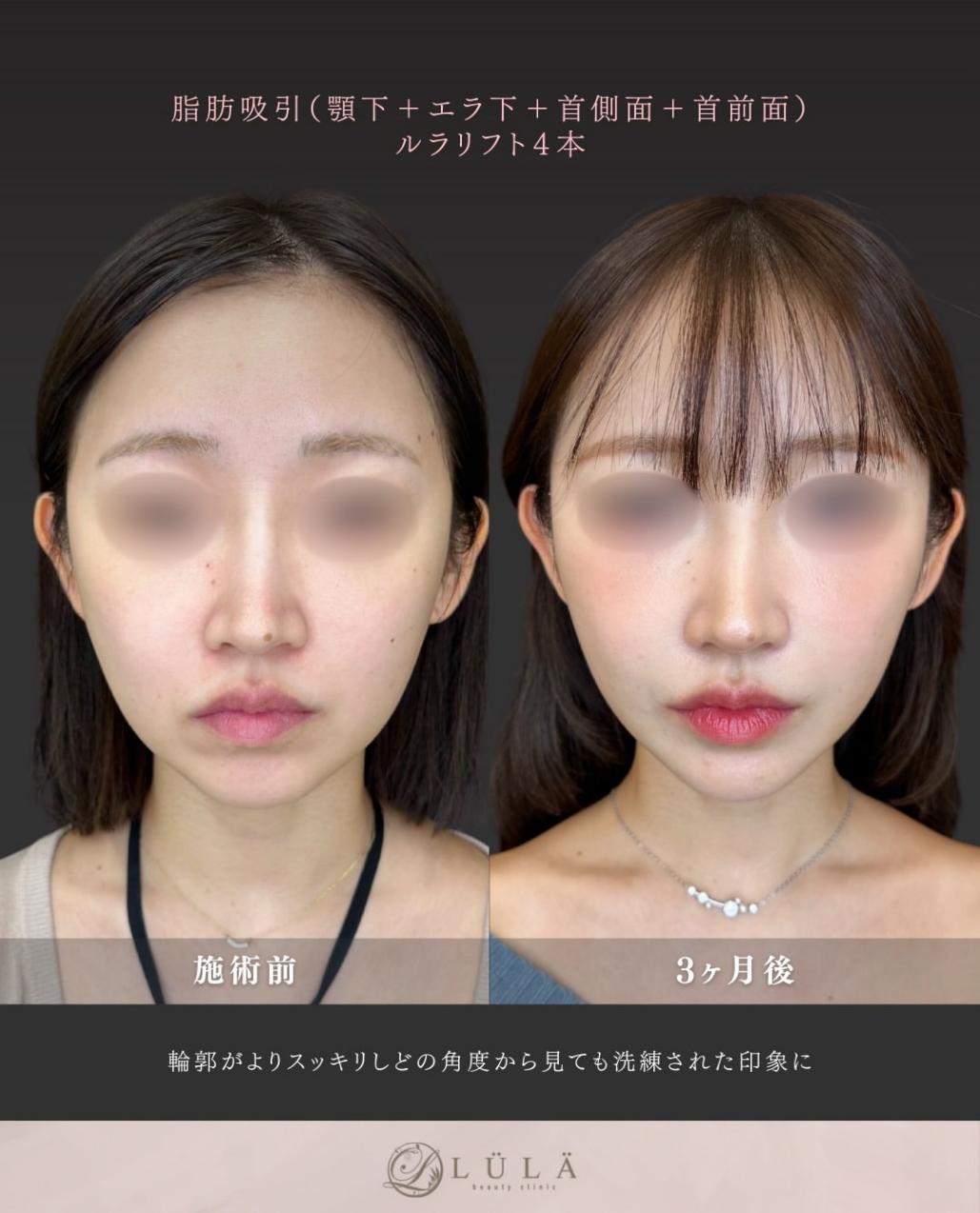 脂肪吸引の症例写真