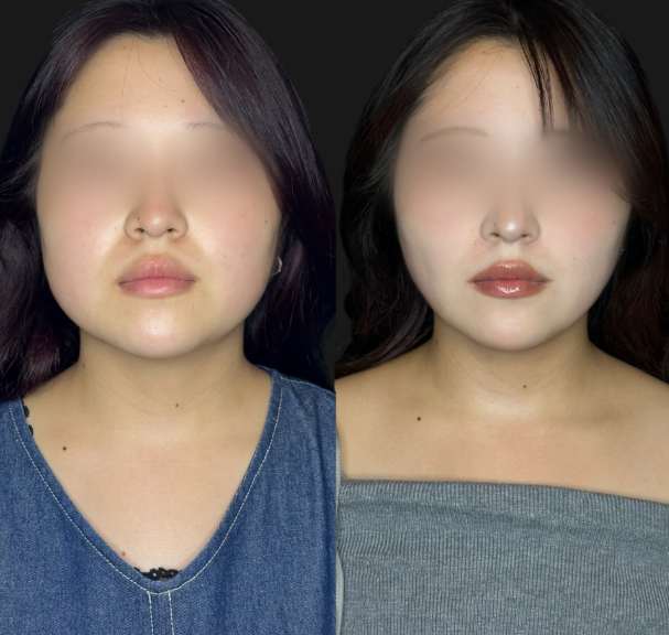 脂肪吸引の症例写真