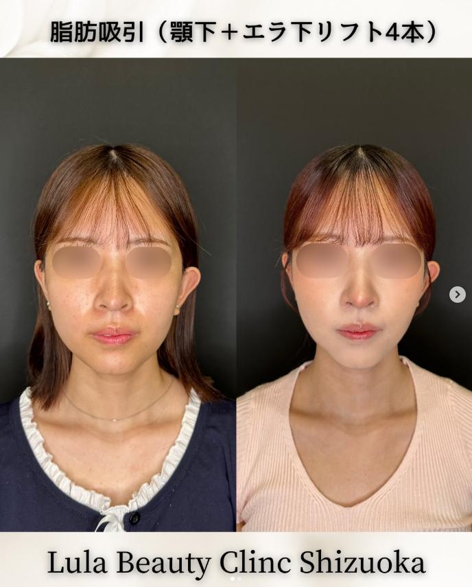 脂肪吸引の症例写真