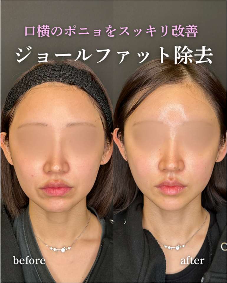 バッカルファット除去の症例写真