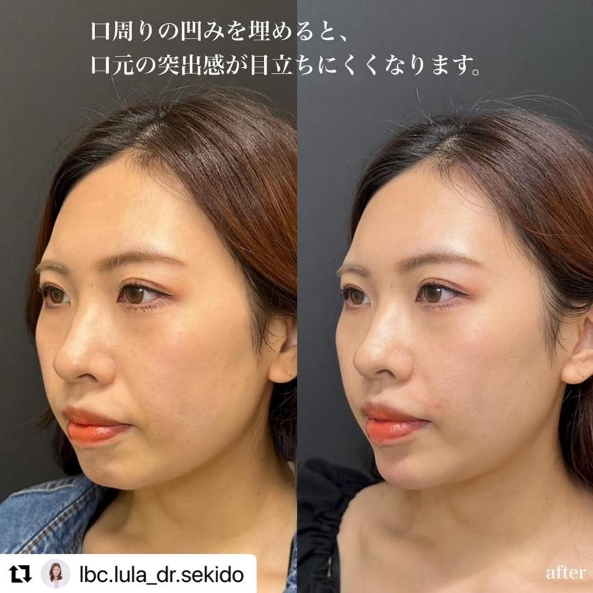 アゴクレヴィエルの症例写真