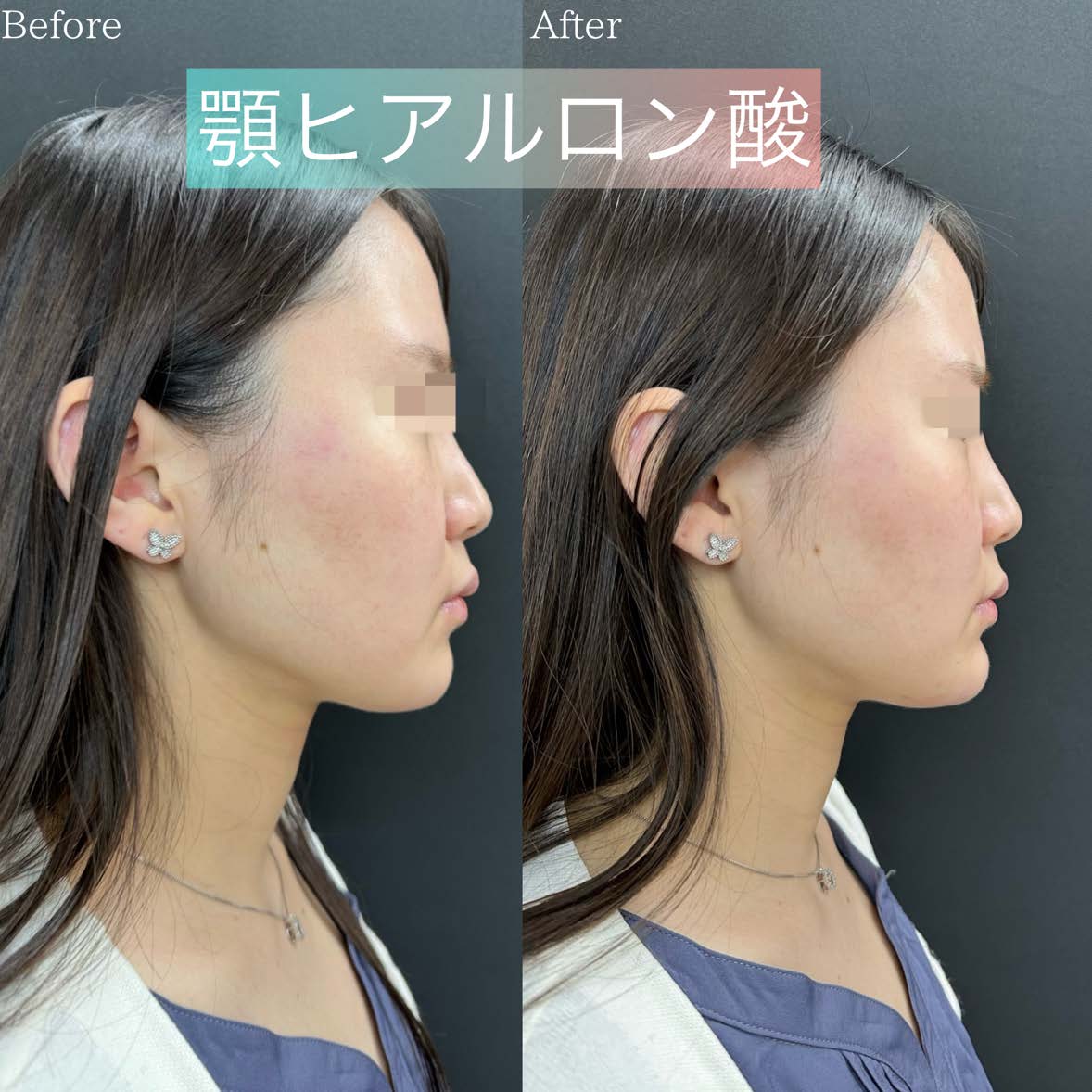 アゴクレヴィエルの症例写真