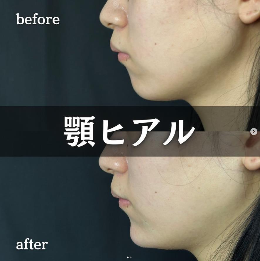 アゴクレヴィエルの症例写真