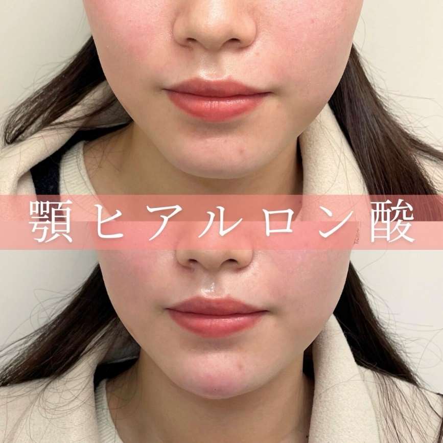 アゴクレヴィエルの症例写真