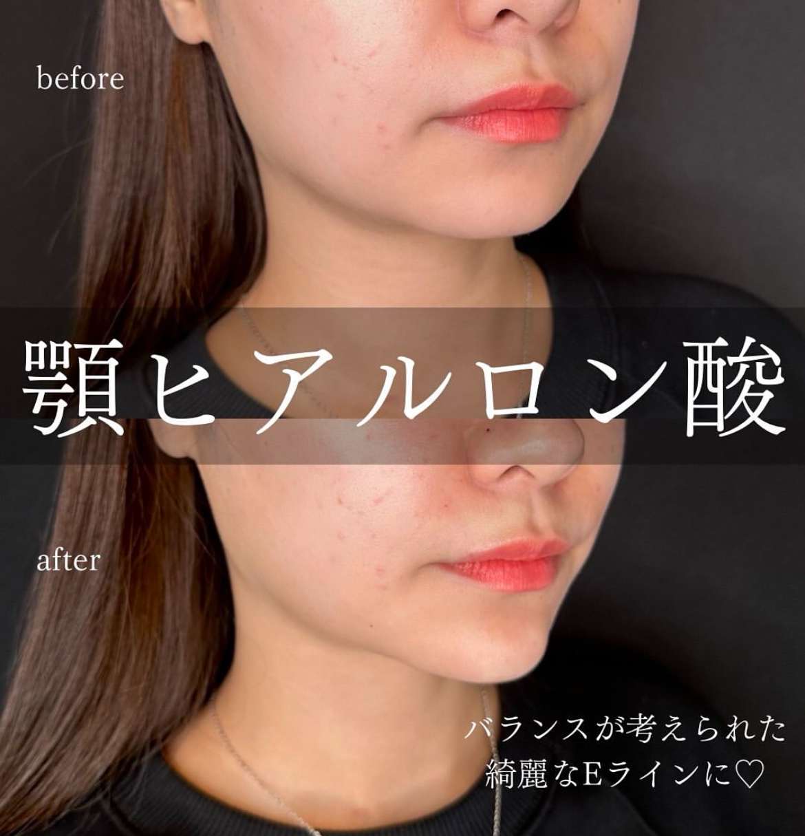 アゴクレヴィエルの症例写真
