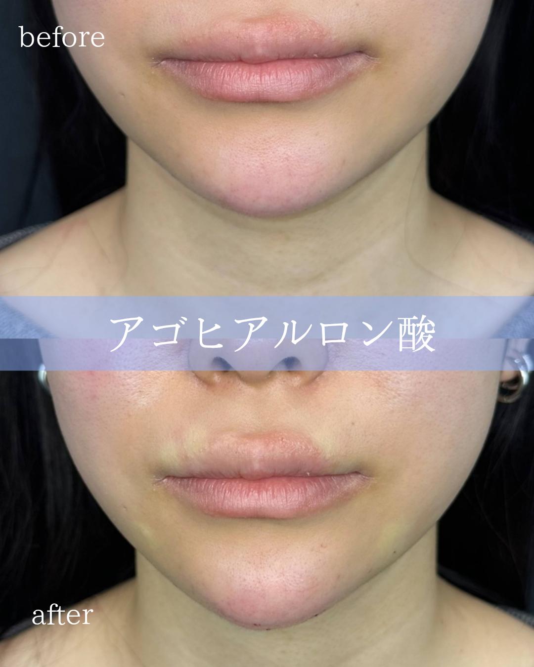 アゴクレヴィエルの症例写真