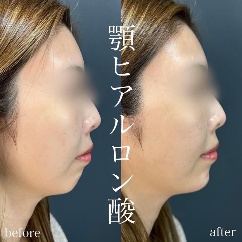 アゴクレヴィエルの症例写真