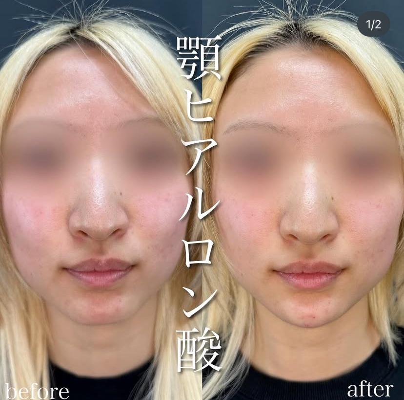 アゴクレヴィエルの症例写真