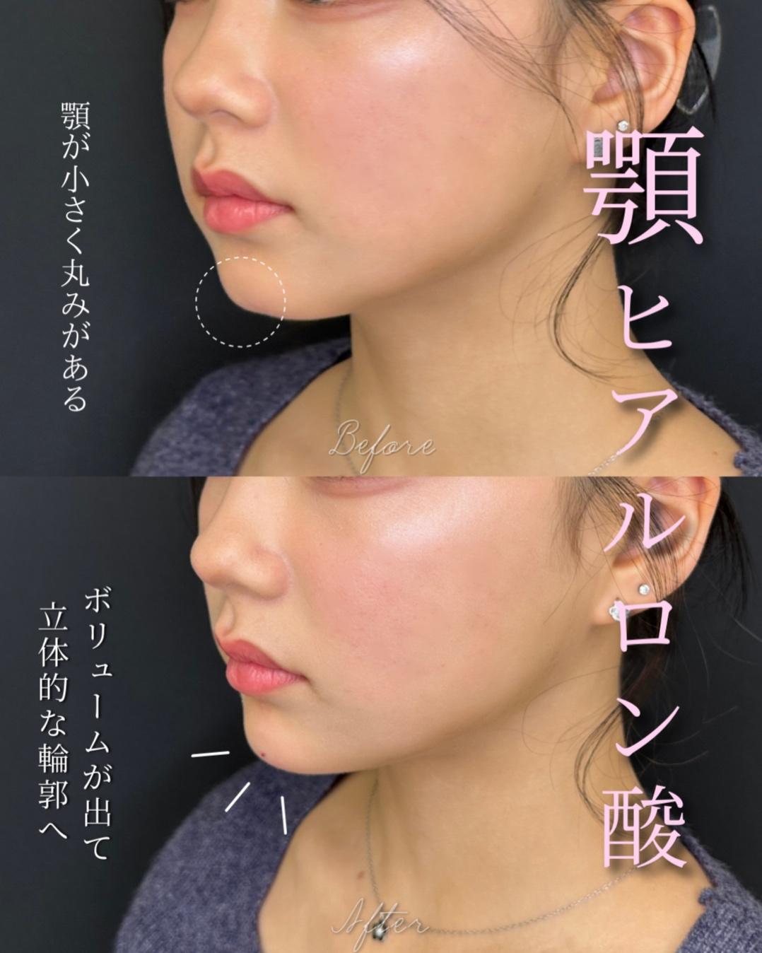 アゴクレヴィエルの症例写真